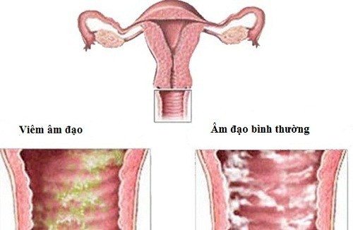 đau âm đạo có nguy hiểm không